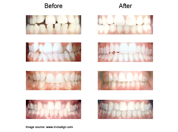invisalign-before-after